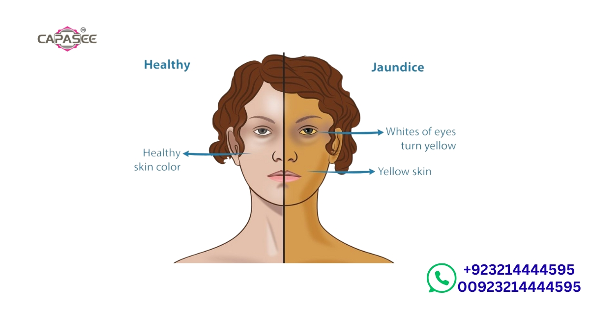 complications-recovery-and-prevention-of-jaundice