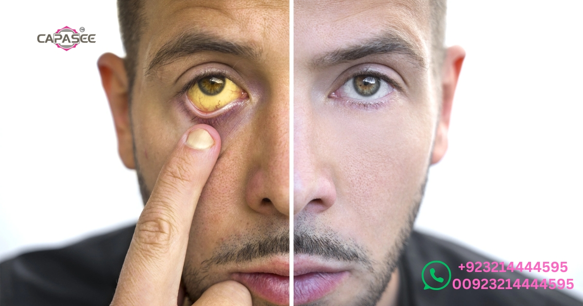 jaundice-treatment-in-pakistan