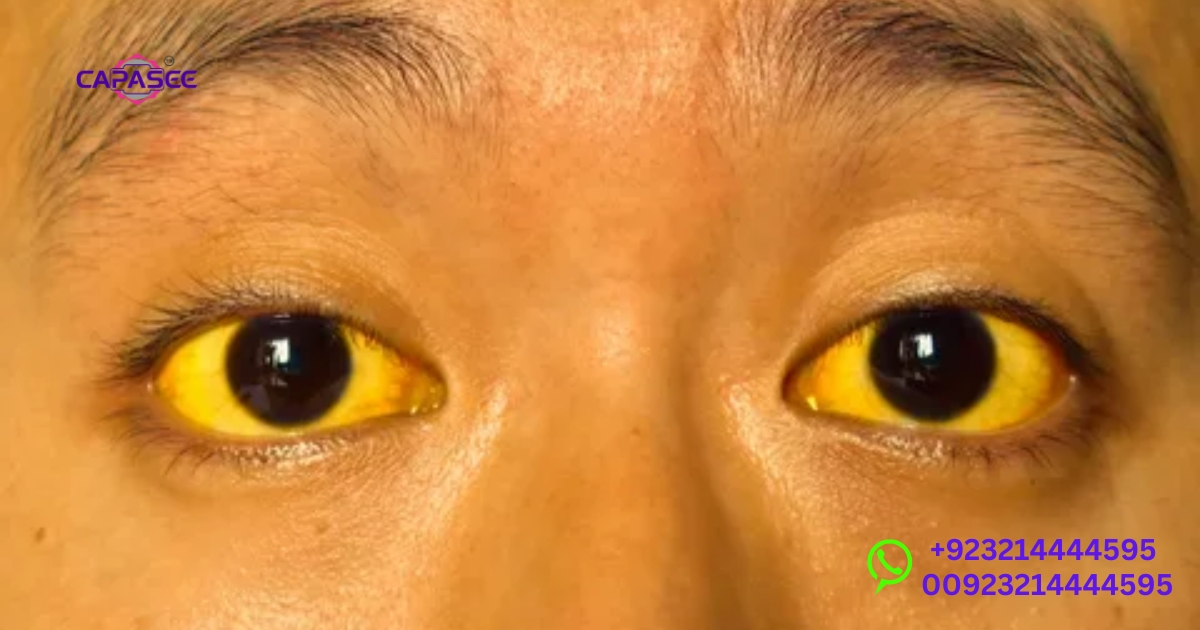Cure Jaundice in Adults: Recovery Timeline