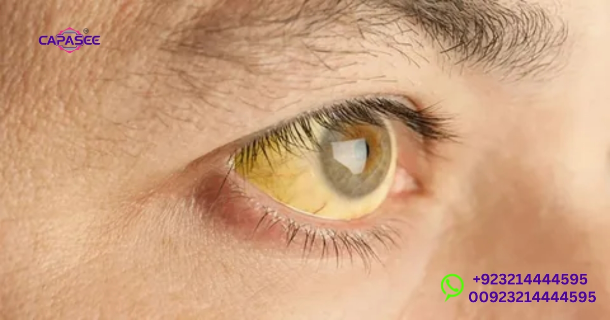 Danger Stage of Jaundice: Warning Signs