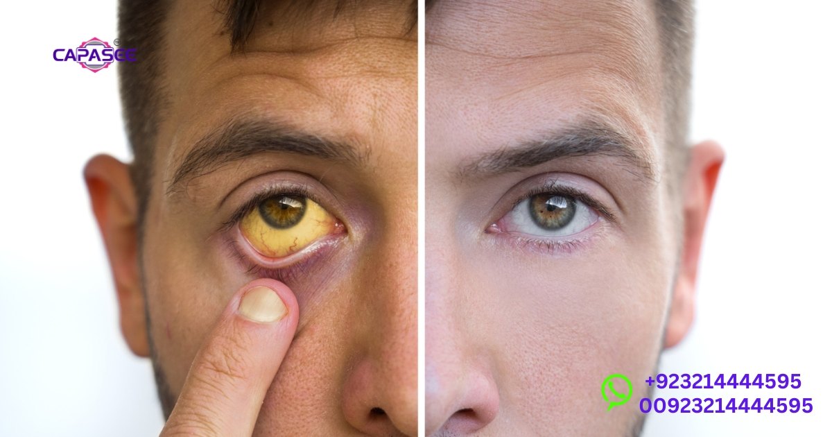 Dangers of Leaving Jaundice Untreated