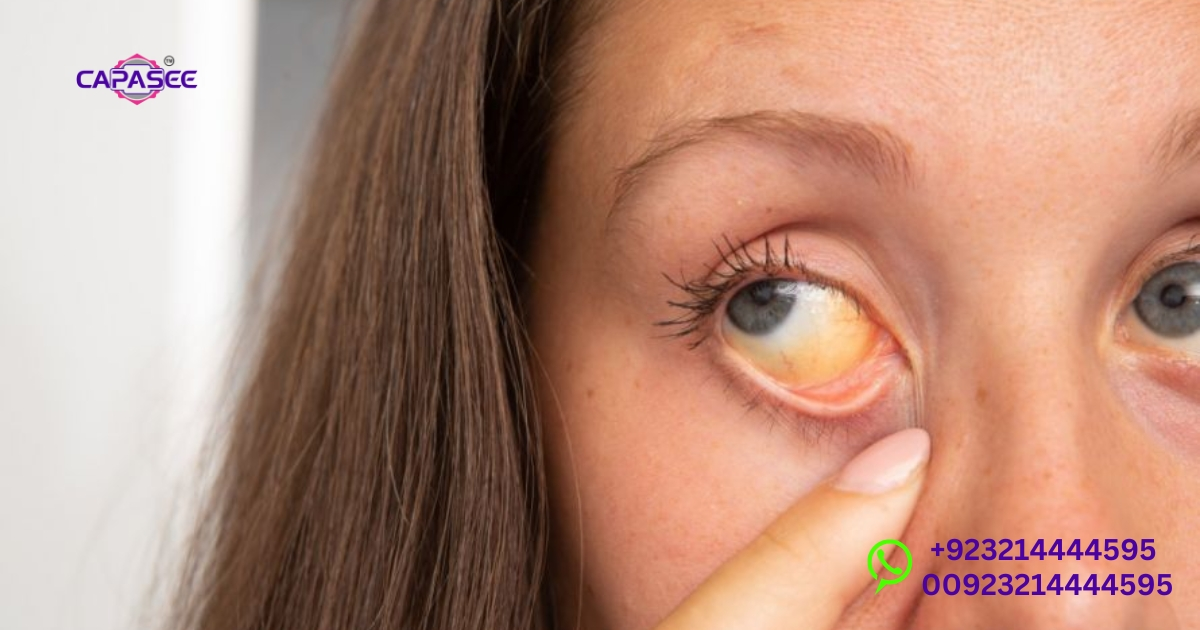 Fastest Way To Cure Jaundice: Proven Methods