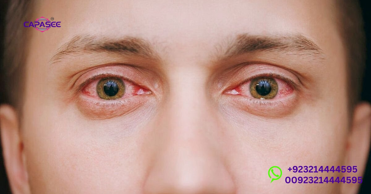 Icteric Phase Symptoms