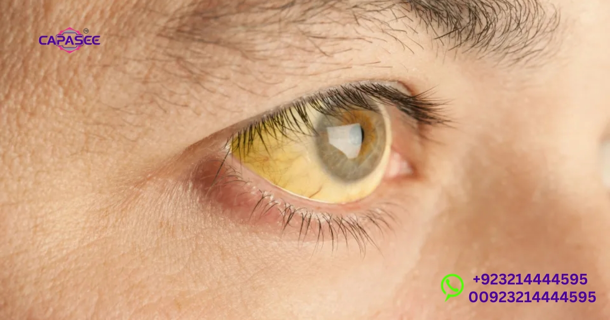 Late Stage Jaundice Prognosis