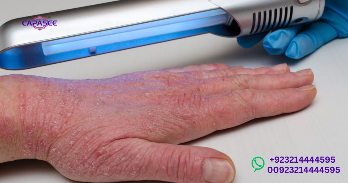 Narrowband UVB Phototherapy Eczema Benefits