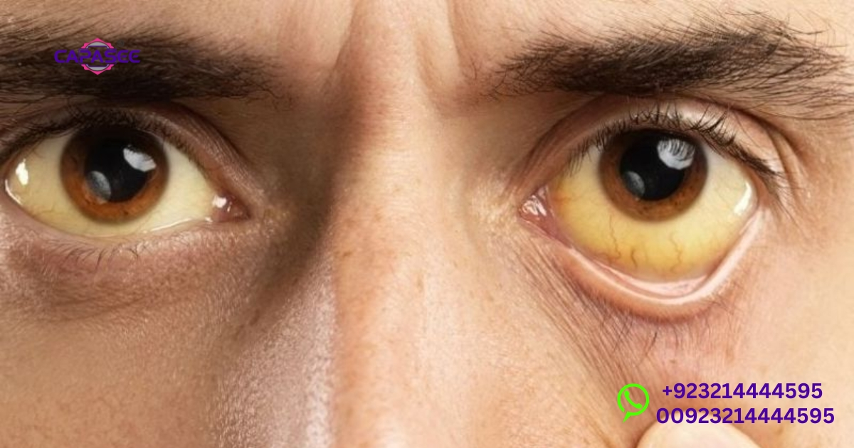 When Is Jaundice Dangerous?