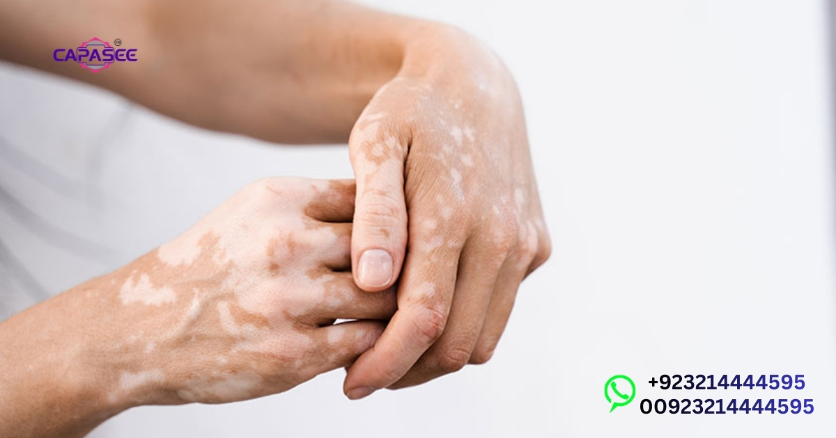 Capasee Phototherapy Light Vitiligo Setup