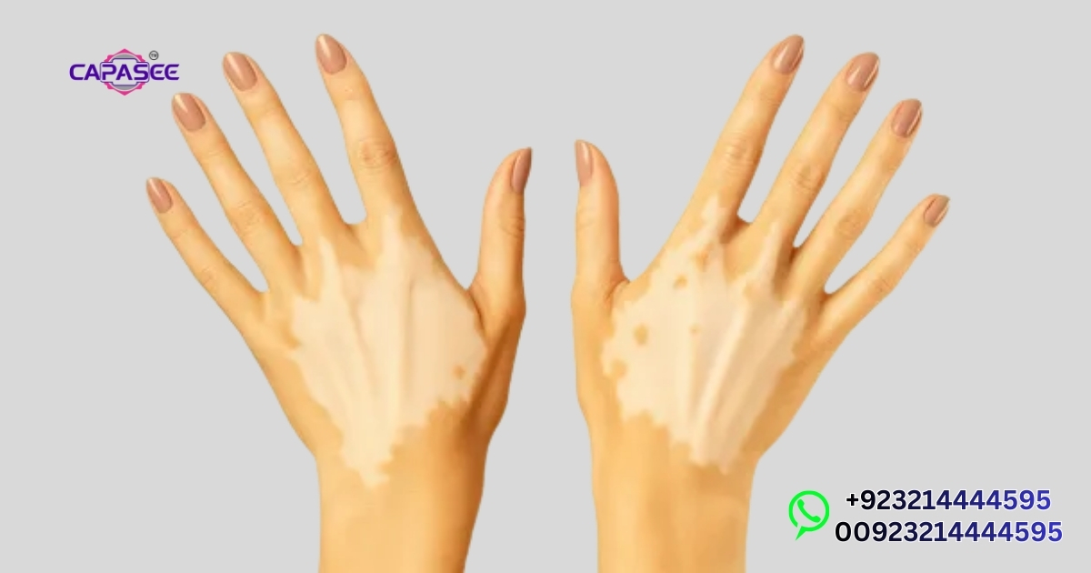 Capasee UV Light Therapy Vitiligo Price Pakistan