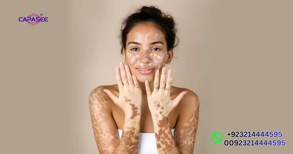 Vitiligo Light Therapy Lahore