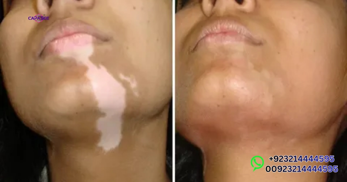 Narrowband UVB Uses for Common Skin Conditions in Pakistan